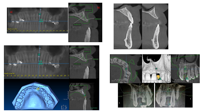 Figure 3: Tomographic and comparative image of the contralateral right upper lateral incisor; virtual planning of the V3 implant for surgical guidance and tomographic verification of the virtual implant placement with the different measurements to the adjacent teeth.