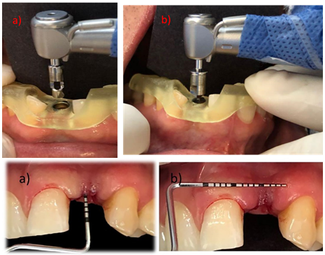 Figure 4: Preparation of the implant recipient site with the IN2GUIDE system, measurement of the length and width of the area with the U. of North Carolina periodontal probe for connective tissue acquisition.