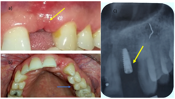 Figure 6: Post-operative 3 months after treatment; a) Increase of keratinized tissue in the vestibular area; b) adequate healing of the connective tissue donor site; c) crestal bone loss.