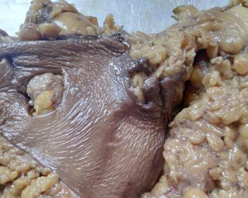 Figure 1: Specimen of right breast with mass totally measuring 21.5 x 17 x 3 cm.