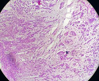 Figure 3: Photomicrograph of Invasive breast carcinoma with invasive lobular carcinoma (H&E Stain, 40x).