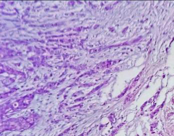 Figure 4: Photomicrograph showing invasive lobular carcinoma (H&E Stain, 100x).