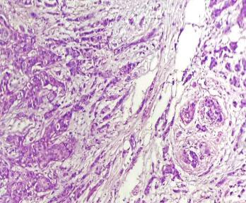 Figure 5: Photomicrograph of invasive breast carcinoma with invasive lobular carcinoma arranged concentrically around normal ducts, giving a targetoid appearance (H&E Stain, 100x).