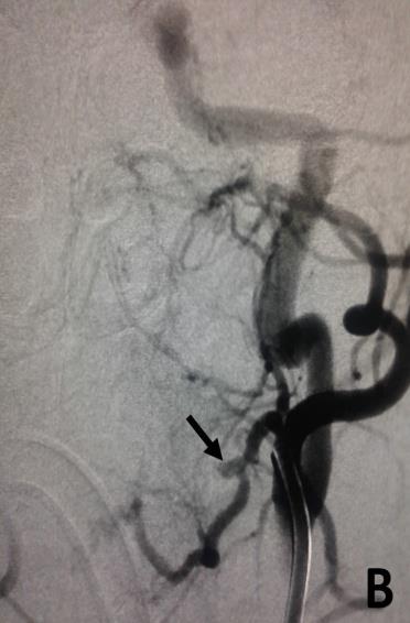 Figure 1: Lingual artery pseudo aneurysm, before embolization. A) Left external carotid artery angiogram in the lateral view showing a small double density at the proximal segment of the lingual artery, suspected to be a small post-tonsillectomy pseudo aneurysm (black arrow). B) Left external carotid artery angiogram in the anteroposterior (AP) view confirming the presence of a small lingual artery pseudo aneurysm (black arrow).