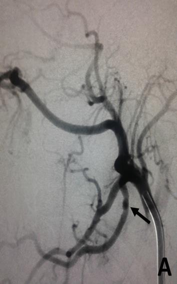 Figure 2: Lingual artery pseudo aneurysm, after embolization. A) Left external carotid artery angiogram in AP view showing the cast of the Histoacryl glue, filling the small pseudo aneurysm (black arrow), as well as the segment of the lingual artery harboring the pseudo aneurysm (white arrows), with no significant distal infiltration of the branches of the artery. B) Left external carotid artery angiogram in the lateral view showing occlusion of the pseudo aneurysm and the lingual artery. The stump of the lingual artery can be seen (black arrow). C) Left external carotid artery angiogram in the AP view showing occlusion of the pseudo aneurysm and the lingual artery. The stump of the lingual artery can be seen (black arrow). Three of the patients had active bleeding, which was evident via contrast extravasation during the diagnostic angiogram, and were controlled during the interventional procedure using tonsil compression forceps. The contrast extravasation disappeared after the injection of the embolizing material. Moreover, the removal of the forceps and examination of the tonsil bed after embolization was essential to confirm the success of the procedure. Furthermore, an immediate surgical exploration and ligation of the injured faciolingual trunk was necessary to deal with a failed embolization in one of these patients.