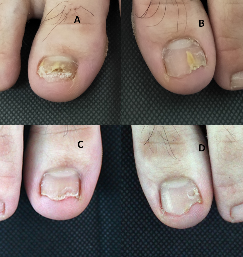 Figure 1: Clinical images of onychomycosis treated with long-pulsed 1064-nm Nd:YAG laser. (A, B) Before treatment. (C, D) After treatment.