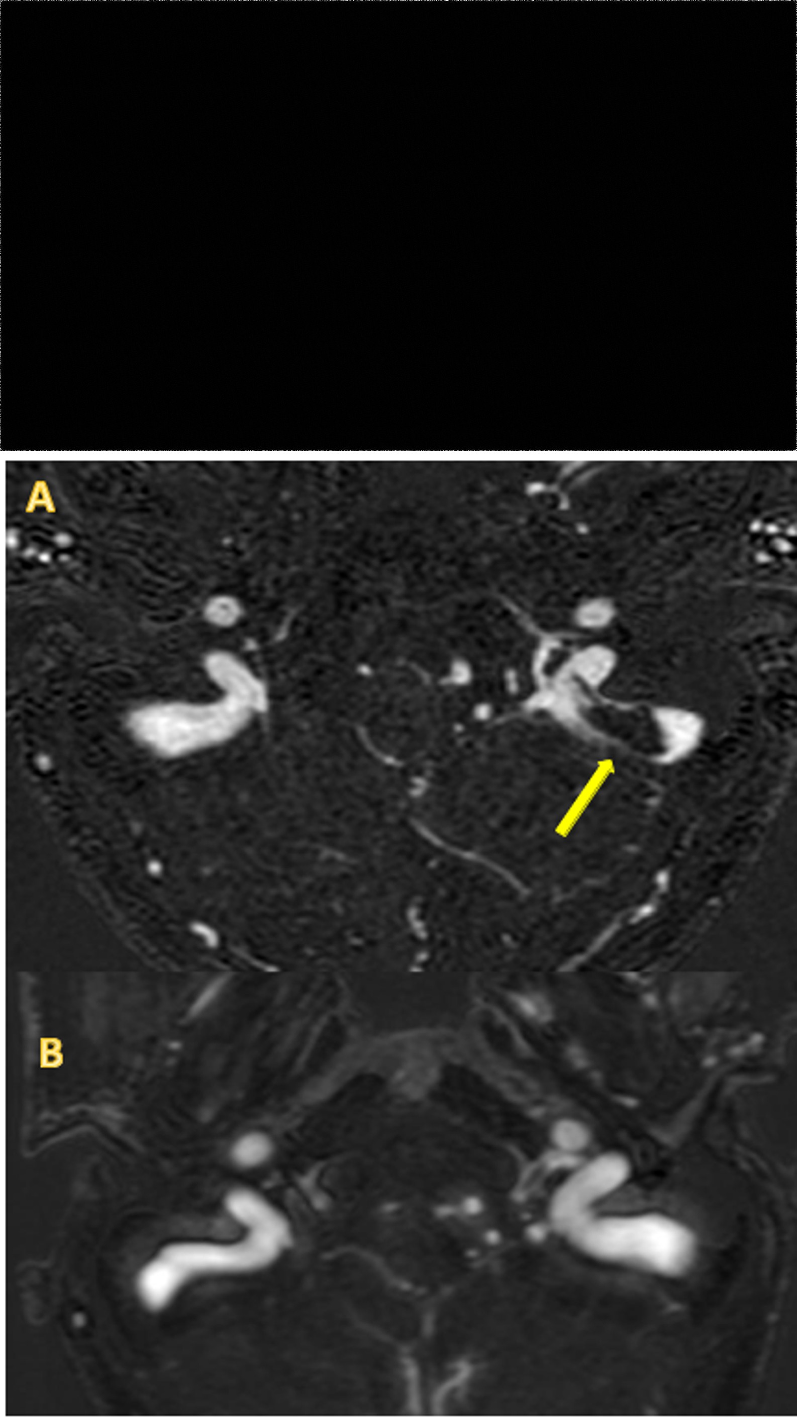 Figure 1: Evolution during hospitalization with the main exams, medications and symptoms reported. CVST- Cerebral Venous sinus thrombosis; IgG – intravenous immunoglobulin; MRI - Magnetic Resonance Image; Day 0– Hospital Admission; Day 8 – Hospital discharge.