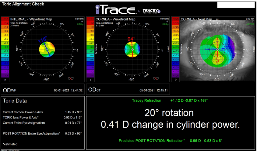 Figure 1: The result of the eye examination after toric lens implantation using the Toric Alignment Check module. The result shows the axes of astigmatism generated by the cornea and the implanted toric lens, as well as the value of uncorrected residual astigmatism. It also shows how the astigmatism value can change after the repositioning of the artificial toric lens.