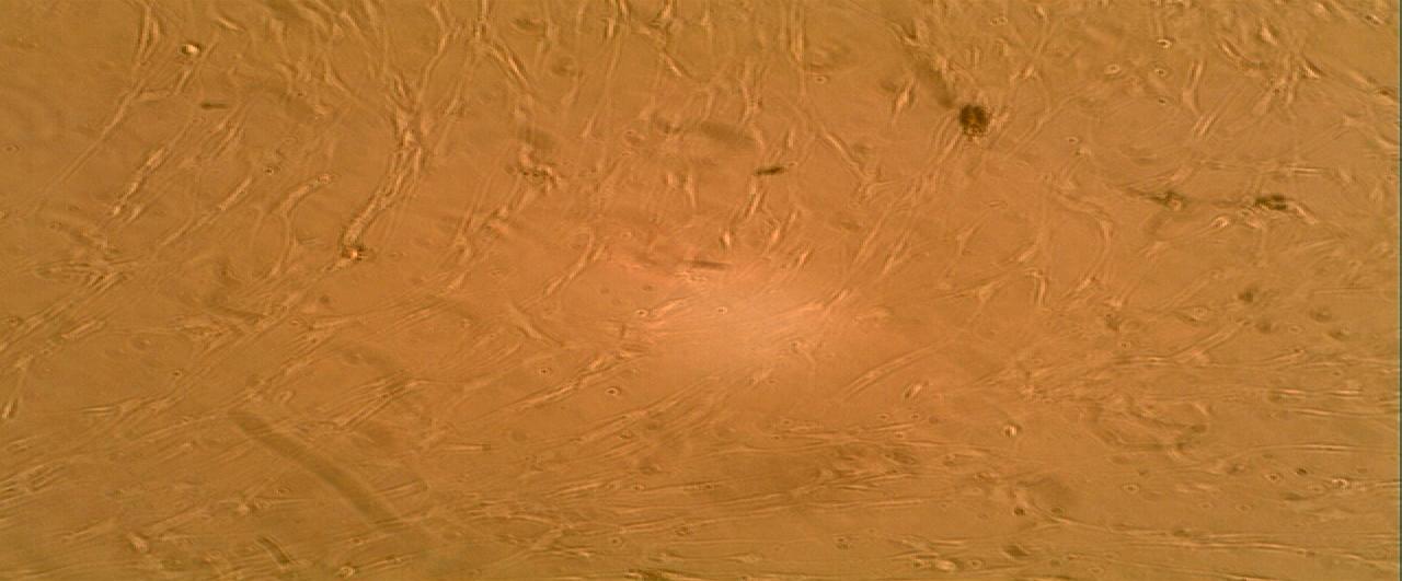 Figure 3: Plexiform neurofibroma cell culture showing an overwhelming cell proliferation of predominantly bipolar cells at confluent (7.2 x103/ml) after the treatment with basic fibroblast growth factor (bFGF) (x 100).