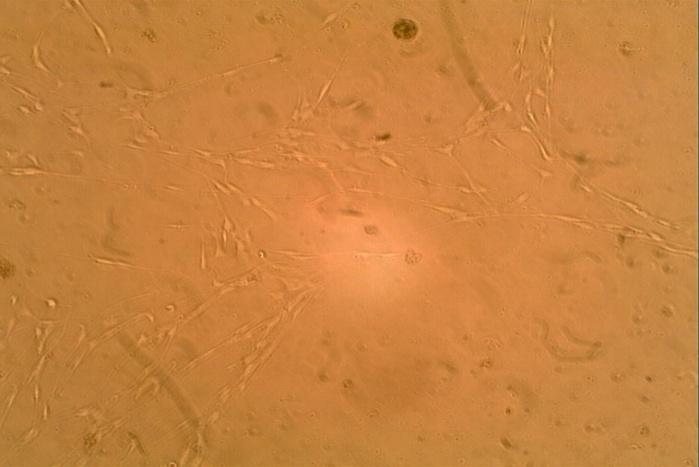 Figure 4: Sporadic neurofibroma cell culture at less than confluence (1.45 x 103/ml) that is made up of largely ‘cells with branching’ (arrow) after treatment with bFGF (x 100).