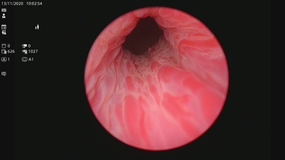 Figure 2: Cystoscopy was shown normal proximal urethral mucosa.