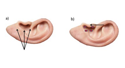 Figure 1: Local retroauricular anesthesia in a three-way maneuver (a); and in concha and tragus (b).