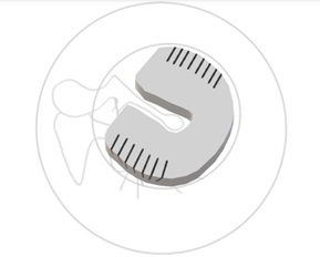 Figure 2: Fringed shield graft design.
