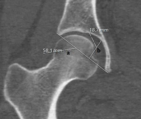 Figure 1: Measurements over CT; a: AD, b: Depth. AD; Acetabular diameter is the name given to the distance between the acetabular ridge nearest to the body of ischium and anterior iliac margin converging the acetabular ridge. Depth; Across the diameter of the acetabulum, a thin metallic strip was placed [9]. Statistical Analysis: Shapiro-Wilk test was used to analyze whether the data were normally distributed. Mann-Whitney U test and Spearman Correlation Analysis were conducted for data analysis. Arithmetic mean (X) and standard deviation (sd), minimum (Min) and maximum (Max) value of the data were found and significance level was accepted as p<0.05. IBM SPSS Statistics 22.0 for Windows package program was used for statistical analyses.