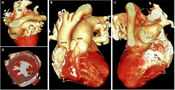 Figure 2: A) Grossly dilated MPA, LPA & RPA; B) Discordant major arterial connection with anterior and rightward position of aorta in relation to MPA; C) Left and right atrium connected to one ventricle; D) Cross-sectional image reveals single ventricle cavity. Abbreviations: LV Left Ventricle; RA Right Atrium; LA Left Atrium; MPA Main Pulmonary Artery; RPA Right Pulmonary Artery; LPA Left Pulmonary Artery; Ao Aorta.