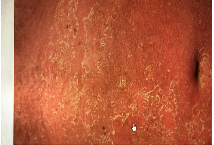 Figure 4: Plasmodium Vivax radical treatment.