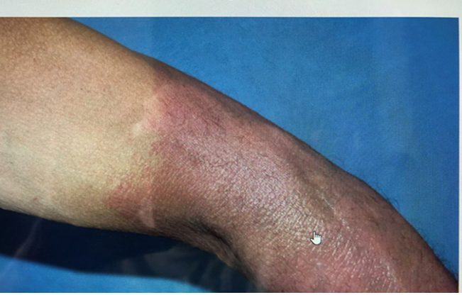 Figure 7: Itchy sunburn pf the body.