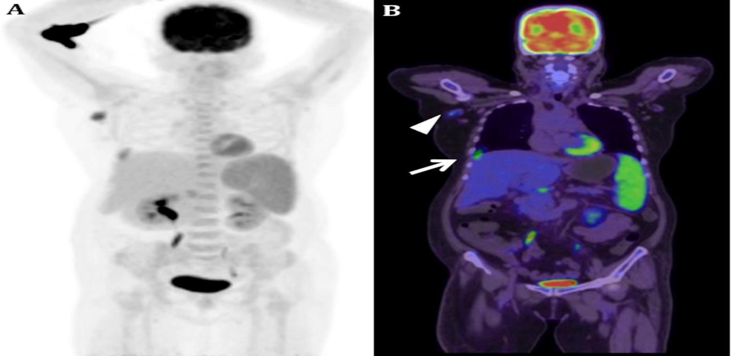 Figure 2: Axial CT (A) image shows hepato-splenomegaly. Axial fused PET/CT (B) image shows diffusely increased FDG uptake (SUVmax 4.8) with linear cold area in the posteromedial aspect, suggesting scar. Spleen measured 14.0 cm craniocaudally. Since the study was performed without intravenous contrast, this finding is not clearly evident in the CT image (A). Axial CT (C) and fused PET/CT images (D) at a distal location show hypermetabolic peripancreatic node. No other significant findings were present in the PET/CT study.