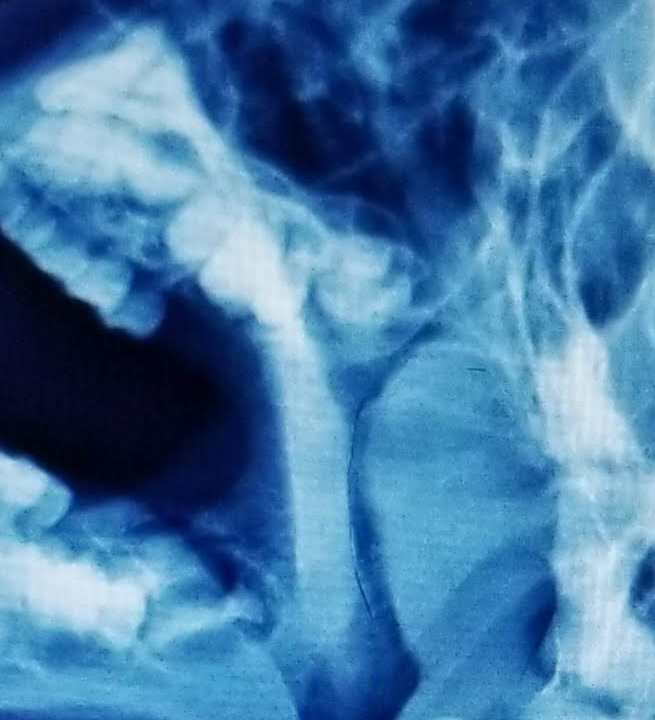 Figure 1: Upper jaw.