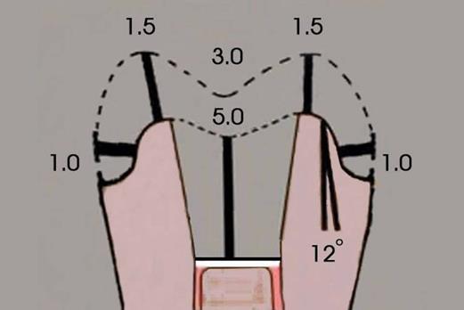 Figure 1: Cavity preparation diagram.