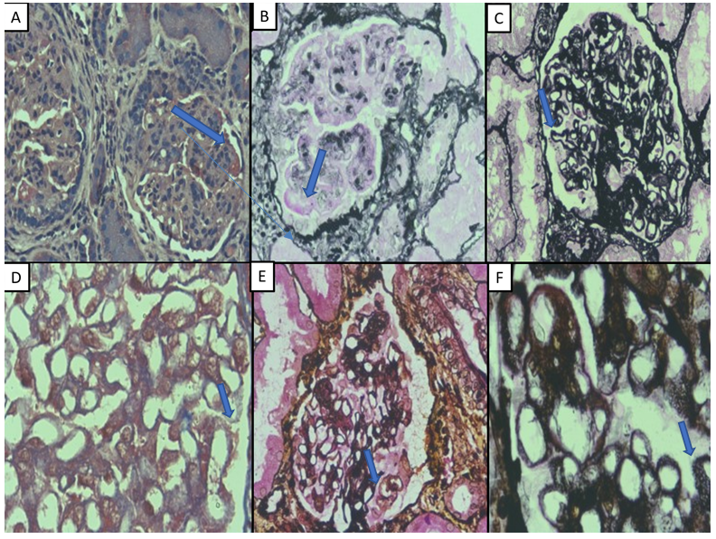 Figure 1: Fuchsinophilic deposits seen in various classes of lupus nephritis using PASM and MT stains (A and B): class IV lupus nephritis, sub-endothelial deposits using MT (X 400) and PASM (X400); (C and D): class V lupus nephritis, sub-epithelial deposits (spikes) using PASM (X400) and MT (X 1000); (E): class II lupus nephritis, mesangial deposits with PASM (X400). (F): class III with class V lupus nephritis, sub-endothelial and sub-epithelial deposits by PASM (X1000).