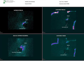 Figure 3: The lymphoscintigraphy, the static scintigraphic images. The Surgery was performed on the day marked, five hours after injection of the tracer; methylene blue was used in conjunction with the radiotracer a periareolar subdermal injection of 1.5 mL was given in the operating room. The radioactive background counts were checked in the lymphatic basin after the excision of the sentinel ‘hot’ node. The first step was an upper out quadrantectomy, and after localizing the scintigraphic hot spots in vivo using the (sterile packed) gamma probe Nuclear Lab DGC II, the site of node localized was crosschecked with the gamma probe.