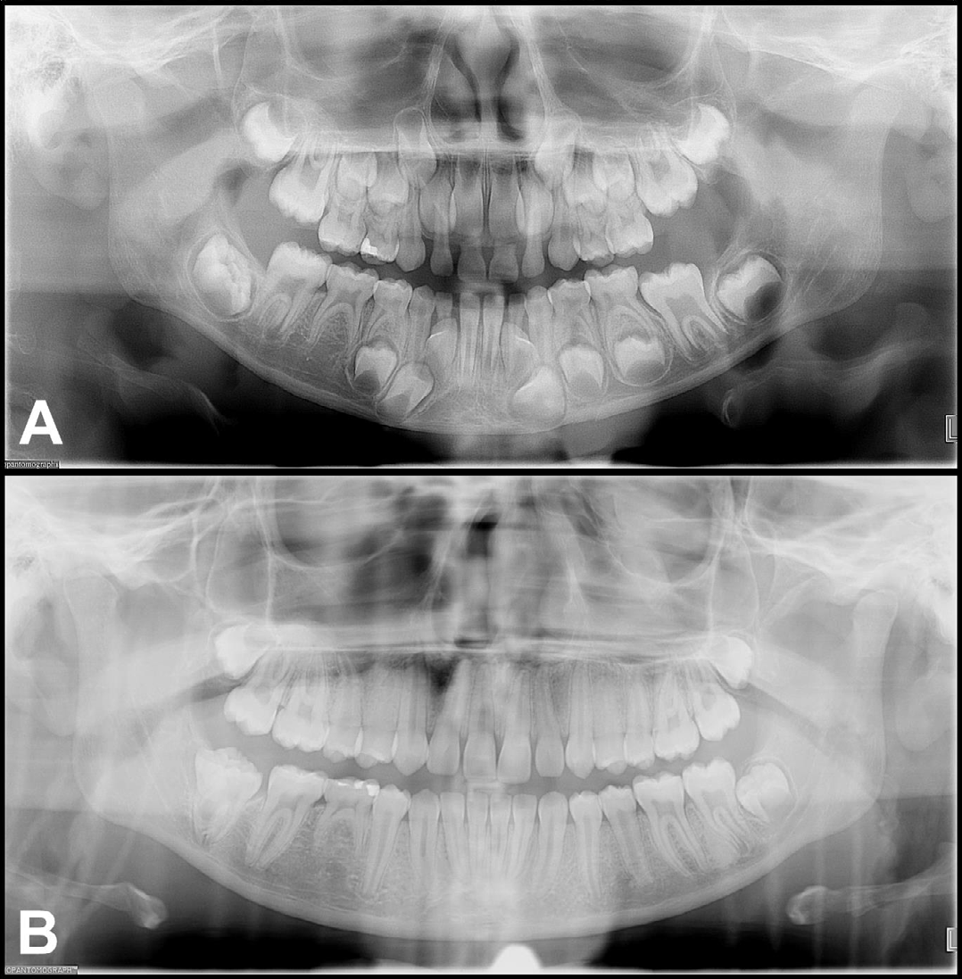 Figure 2: Panoramic radiographs from case 2 taken during mixed dentition (8 years) and permanent dentition (16 years) stages showing non-syndromic, generalized radiculomegaly affecting both primary (A) and permanent dentition (B). Note congenital absence of #s 29 and 31 with gemination of #32. Multiple linear radiopacities are seen vertically on right and left side of the radiographs consistent with braids of hair. The polymeric additives in hair products can be the reason as to why these braids are visible on panoramic radiographs.
