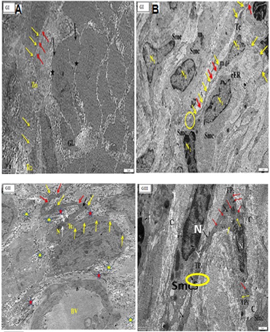Figure 7: Electron micrographs of cross sections in the uterus of adults non-pregnant rat (GI) (A) showing endometrial stroma containing endometrial gland with lumen (GL) with epithelium (black arrows) and nuclei (star). There are two podomers (yellow arrows) and podoms (red arrows) along the telopodes. (B): showing parallel arranged smooth muscle cells (SMCs) with nuclus (N1), Telocyte (TC) is present inbetween smooth muscles with a small body containing the nucleus (N2), and three apparent telopodes; (red arrows), podoms (yellow arrows) and the encircled area showing the close connection of telopodes with the adjacent Smc. Note, mitochondria (m), rough endoplasmic reticulum (Eer). (O.M, x4000).