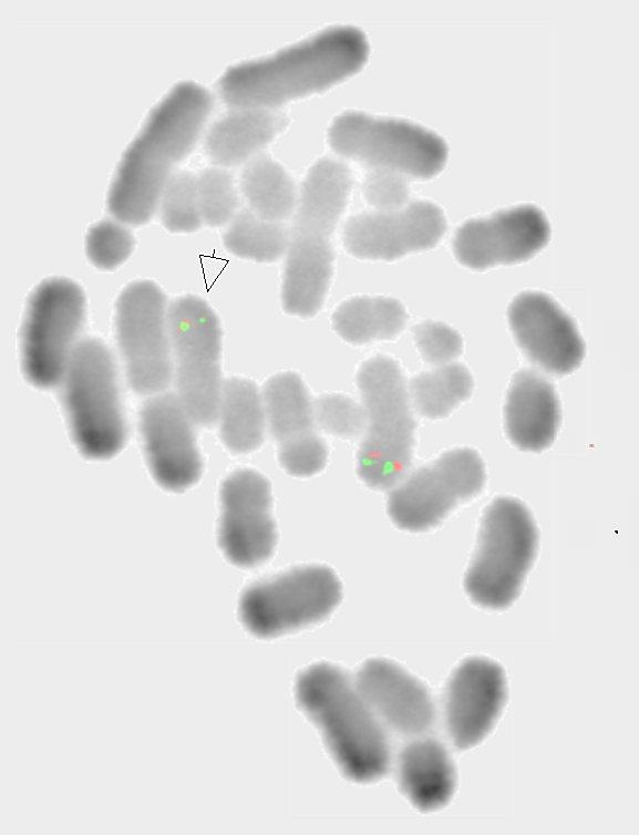 Figure 2: Fluorescent In-situ Hybridization (FISH), Case 1. FISH on metaphase showing normal localization of EVI1 (3q26.2) FISH signals on chromosome 3.