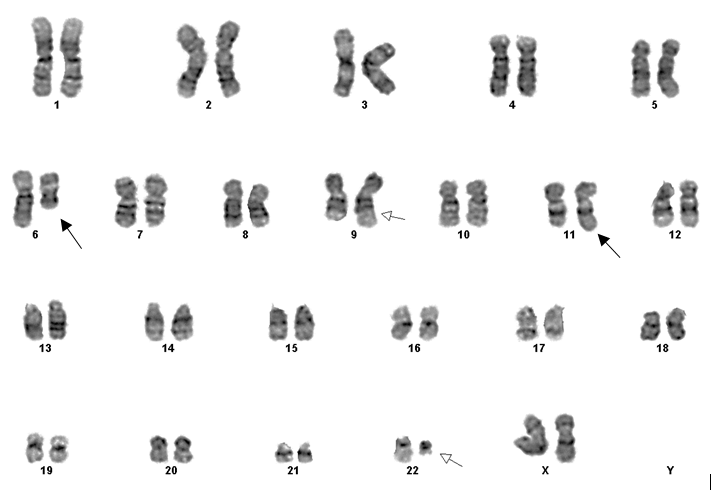 Figure 3: Conventional Cytogenetic Study, Case 2. Karyogram showing 9;22 translocation (indicated by grey arrows) along with deletion of 6q (indicated by black arrow) and additional unknown genetic material on 11q arm (indicated by black arrow).