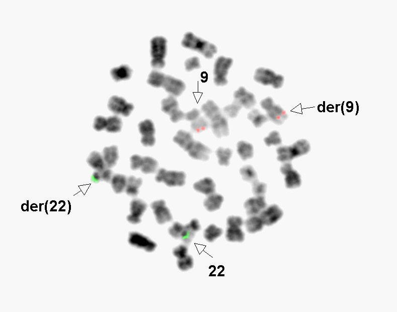 Figure 4: Fluorescence In-situ Hybridization (FISH), Case 2. FISH on metaphase showing normal localization of ABL1 (9q34) red signals and BCR (22q11.2) green signals on normal and abnormal chromosomes 9 and 22.