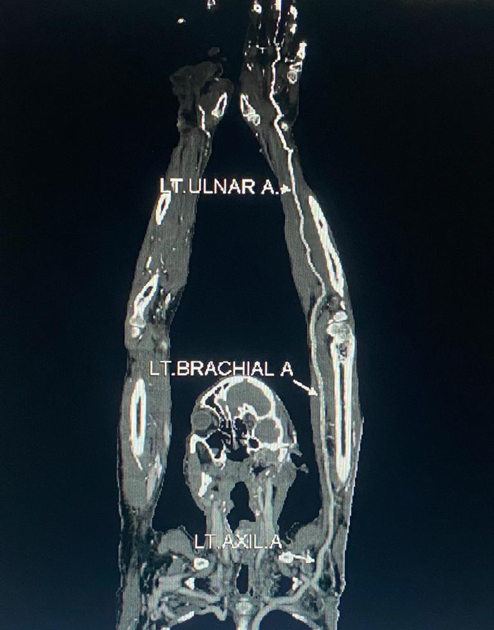 Figure 1: View of the patient in prone position with both arms raised showing the left axial and ulnar artery in MIP image.