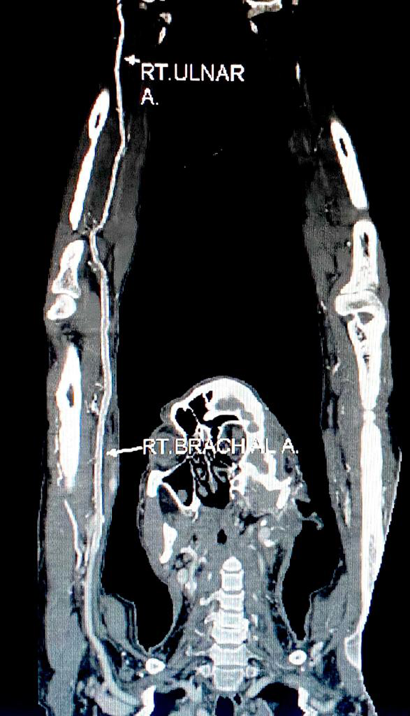 Figure 2: CT angiogram showing the right brachial and ulnar artery in MIP & showing diffuse athermanous calcified plaques.