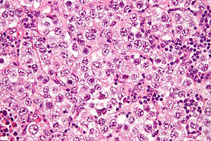 Figure 1: Seminoma depicting well defined tumour cells imbued with abundant cytoplasm, polygonal nuclei, prominent nucleoli along with intermingled fibrous tissue septa and lymphocytic infiltrate.