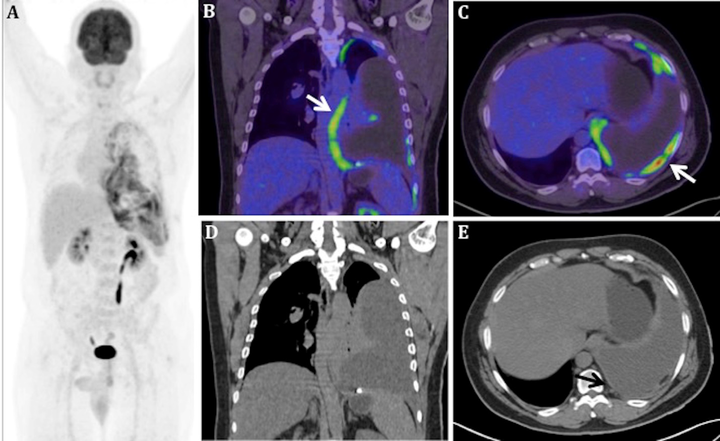 Figure 2: Axial fused PET/CT (A) image shows diffuse FDG avidity (SUVmax 6.3) in periphery of the basal segments of the collapsed lower lobe (arrows in A), likely representing visceral pleural involvement, since the contrast enhanced CT done previously did not show any focal hypo attenuation or nodular change (arrows in B). Sagittal CT (C) and fused PET/CT (D) show FDG avid (SUVmax 7.6) nodular fat stranding in the left epiphrenic region (arrows in C and D), adjacent to the mediastina pleura. Eosin-Hematoxylin (100x) stain (E) shows granulomas with multinucleated Langham’s giant cell (arrows), central caseation necrosis and no malignant cell. Ziehl Nielson’s (400x) stain (F) shows beaded AFB (arrow).