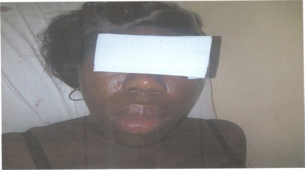 Figure 1: Acromegaly showing enlarged nose, lips and lower jaw.