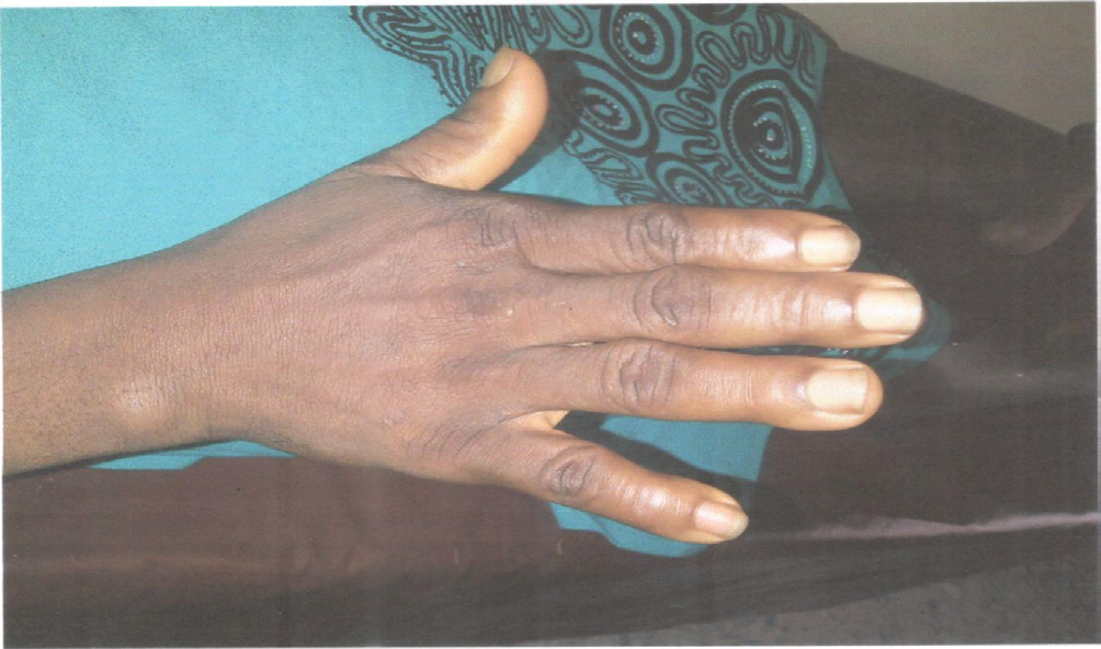 Figure 2: Acromegaly showing enlarged hand.
