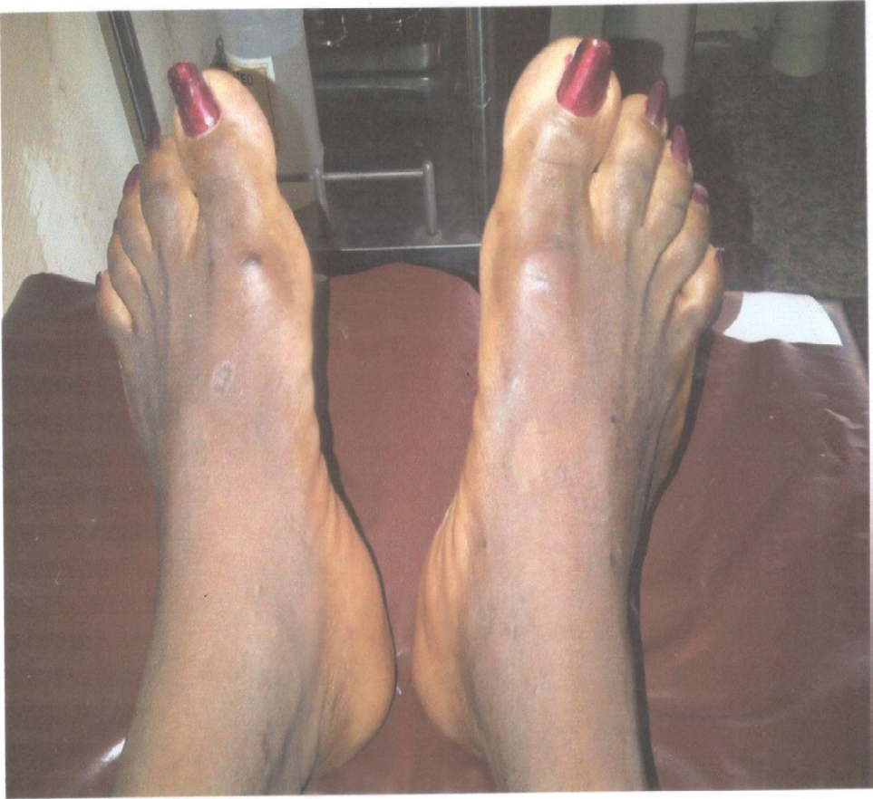 Figure 3: Acromegaly showing enlarged feet.