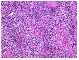 Figure 2: Dysgerminoma depicting nests and cords of tumour cells with minimal cytoplasm, hyperchromatic nuclei, coarse chromatin and circumscribing fibrous tissue septa infiltrated by neutrophils.