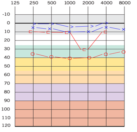 Figure 1: Audiogram of the patient with Wilson’s disease.