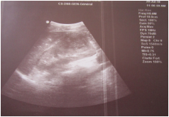 Figure 1: Ultrasound image of upper antero-polar abscess of the kidney.