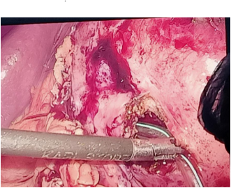 Figure 2: CT scan image of an anterior and superior polar abscess of the left kidney.