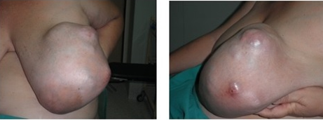 Figure 1: Giant benigns phyllodes tumor of the left breast with 11 years of evaluation. A: Front View; B: Side view.