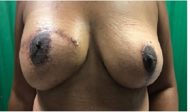 Figure 3: One month postoperative period of a patient who underwent right simple mastectomy with immediate reconstruction with a breast implant due to phyllodes tumor of the right breast and left mastopexy using the thorek technique.