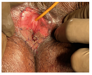 Figure 1: Graft placed over the raw area.