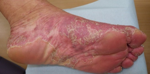 Figure 1: A, B: Hyperkeratotic erythema and flaky vesicles (arrow) on the palm and sole C: Affected fingers and fingernail (arrow head) D: Various sized hyperkeratotic erythematous plaques on the trunk and extremities