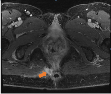 Figure 1: Enhancing sinus tract originating from the right coccyx.
