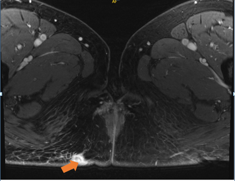 Figure 2: Sinus tract extending infer laterally to the right gluteal fold.