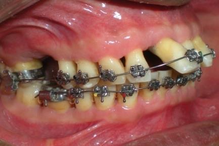 Figure 10: Post treatment facial and intra-oral photographs.
