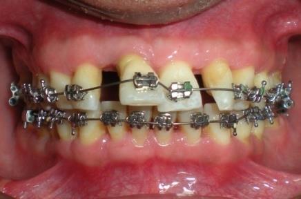 Figure 11: Post treatment OPG and Lateral Cephalogram.